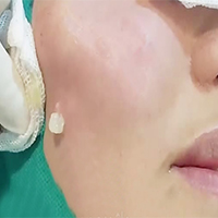 تخلیه ژل گونه - دکتر امین جعفری - متخصص پوست، مو و زیبایی