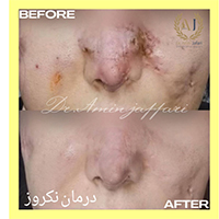 تخلیه ژل بینی - دکتر امین جعفری - متخصص پوست، مو و زیبایی