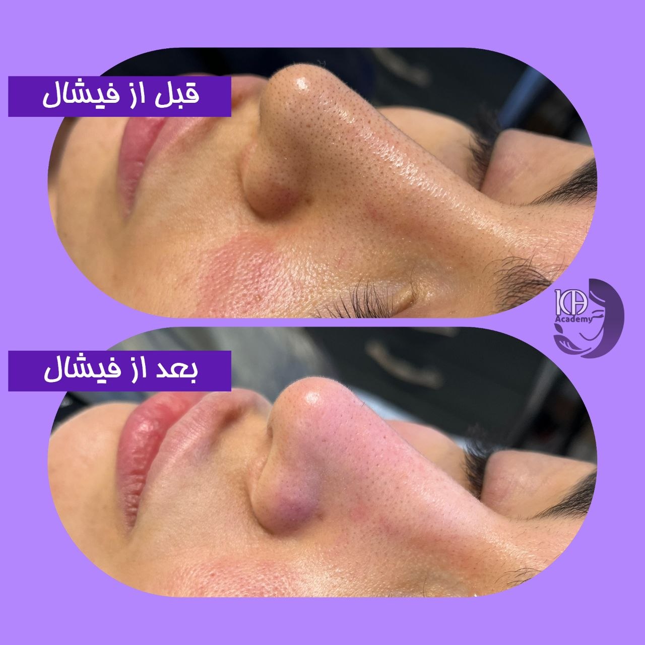 پکیج لمس مهتاب - پاک سازی و لایه برداری پوست