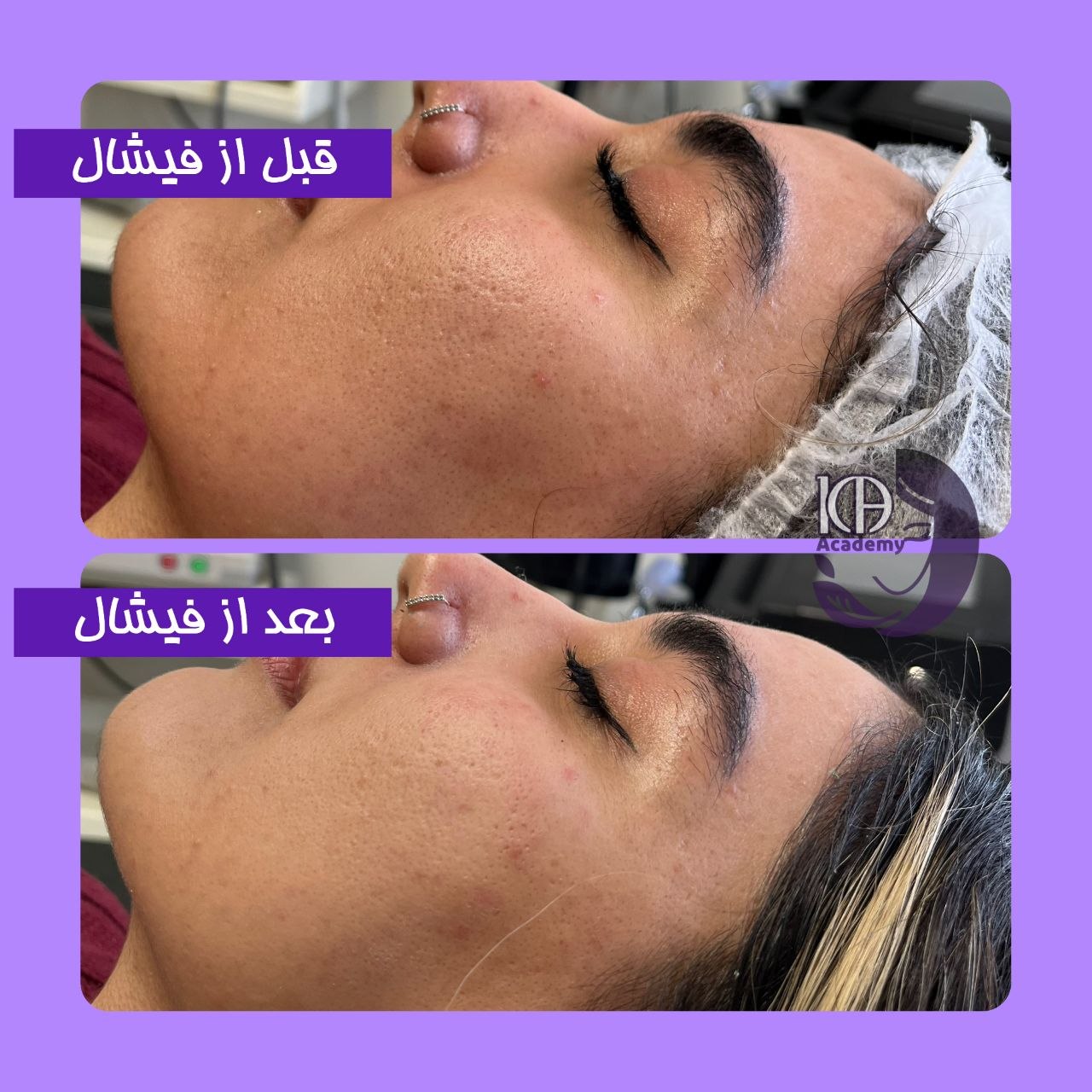 پکیج گلبرگ مخملی - پکیج فیشال به همراه ماساژ صورت
