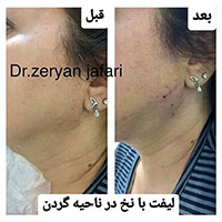 لیفت کامل صورت بدون جراحی در یک جلسه - دکتر زریان جعفری