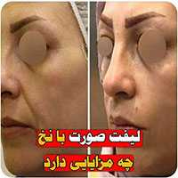 لیفت صورت با نخ کاگ - دکتر زریان جعفری