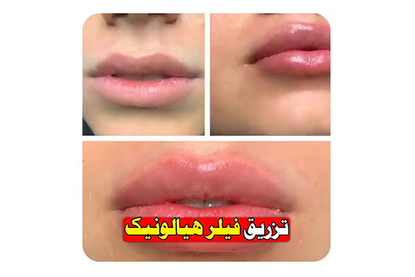 تصویر تزریق ژل لب - دکتر زریان جعفری