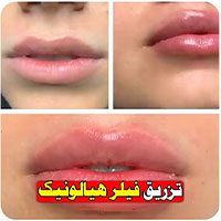 تزریق ژل لب - دکتر زریان جعفری