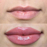 تزریق فیلر و ژل - دکتر مهرنوش گرانمایه - پوست، زیبایی و زیبایی