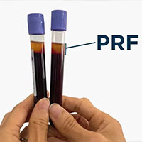جوانسازی با تزریق PRP و PRF توسط دکتر مهرنوش گرانمایه