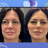 فرم دهی و لیفت بدن، صورت و گردن - رفع افتادگی پوست پس از لاغری با آمپول