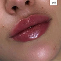 فیلر لب روسی یک سی سی در کلینیک زیبایی نیل