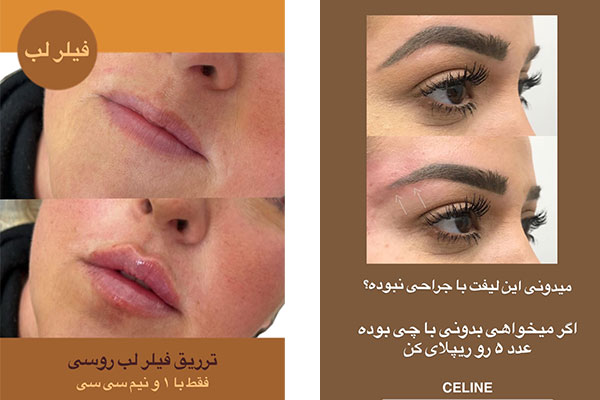 تصویر لیفت شقیقه در کلینیک زیبایی نیل