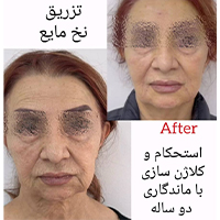 خرید نخ کلاژن ساز مایع - دکتر شیرین امیر حسنی