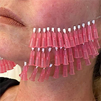 نخ کلاژن - دکتر شیرین امیر حسنی - پوست، مو و زیبایی