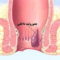 درمان هموروئید با جراحی و بدون جراحی - دکتر حسین تاروردی زاده - متخصص جراحی عمومی و لاپاراسکوپی