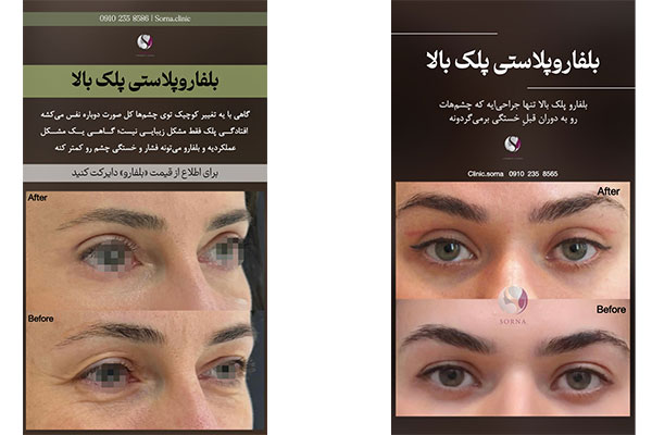 تصویر جراحی پلک (بلفاروپلاستی) در کلینیک زیبایی سرنا