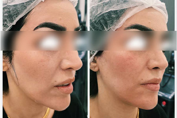 تصویر کانتورینگ صورت جهت تحلیل ناشی از تزریق آمپول لاغری