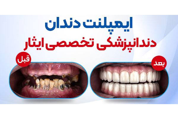 تصویر 🔹ایمپلنت دندان در کلینیک دندانپزشکی تخصصی ایثار