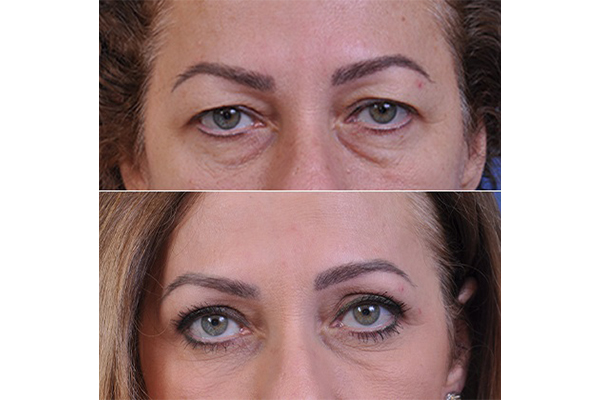 تصویر بلفاروپلاستی - کلینیک زیبایی پارسیان (پارسیان بیوتی)