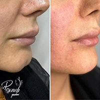 تزریق انواع جوانسازها - دکتر پونه یزدانی - مطب تخصصی پوست، مو و زیبایی و لیزر