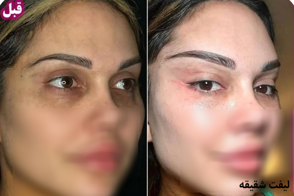 تصویر لیفت شقیقه - کلینیک زیبایی پارسیان نور