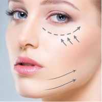 اندولیفت صورت - کلینیک زیبایی رزیبا