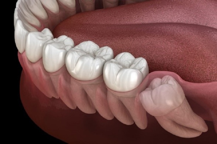 تصویر کشیدن دندان 